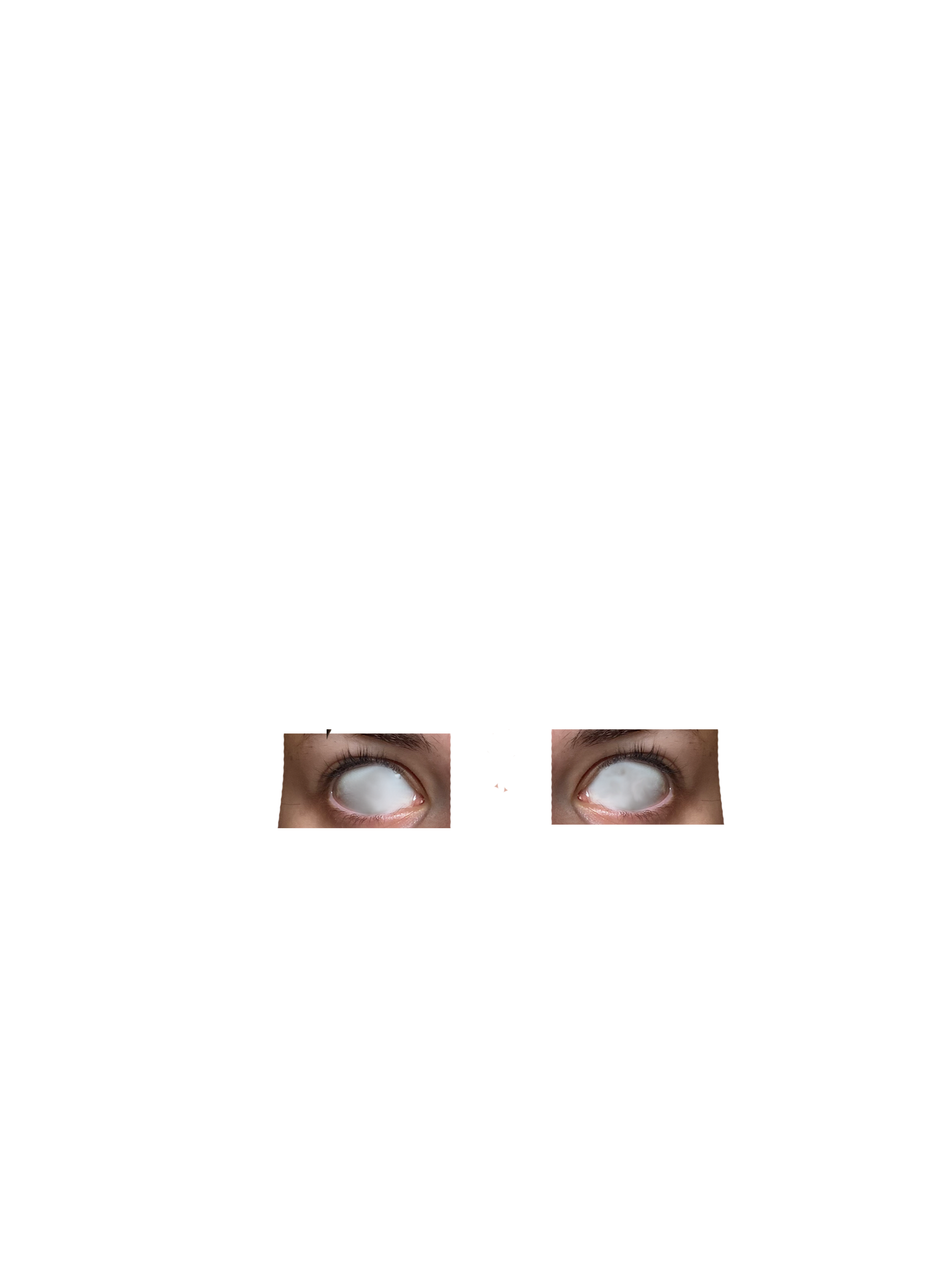 Eye whites